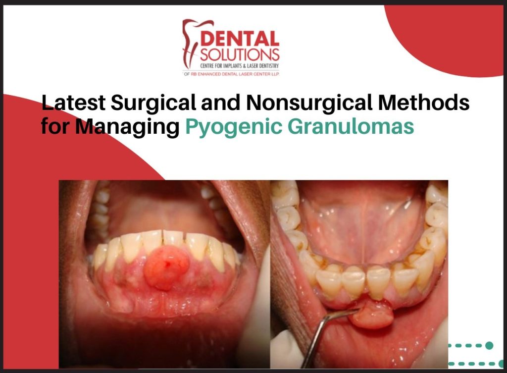 Pyogenic Granulomas